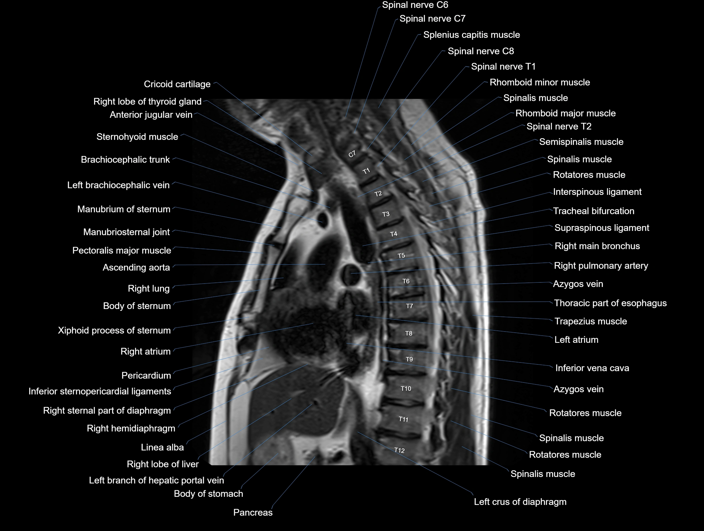 MRI chest (thorax) coronal  cross sectional anatomy 3T radiology  image-img-00001-00019.webp